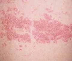 Проявления герпетической инфекции на коже