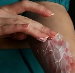 Жжение кожи после нанесения лекарств3