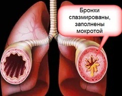Симптомы кашля курильщика2
