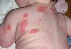Аллергия на цитрусовые: симптоматика болезни
