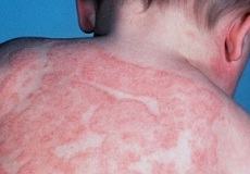 Высыпания на коже при атопическом дерматите
