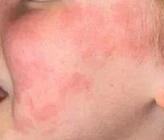Как лечится аллергия на цитрусовые