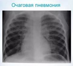 Информативность рентгенологической диагностики при очаговой пневмонии