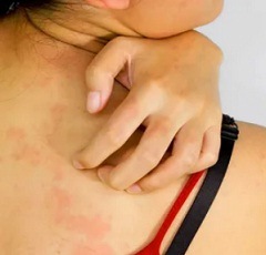 Аллергия на Аспирин симптомы2