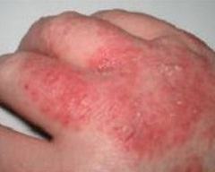 Гиоксизон показан для лечения дерматита