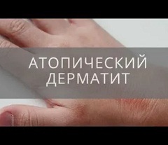 Лечение атопического дерматита3