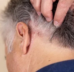 Симптомы псориаза1