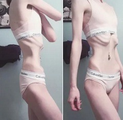 Причины анорексии3