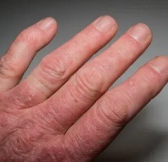 Симптомы псориаза3