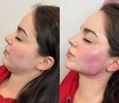 Осложнения в косметологии3