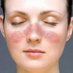 Этиологические причины васкулита кожи
