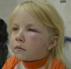 Анафилактический шок на антибиотики1