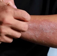 Причины контактного дерматита1