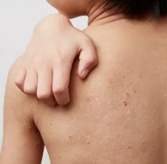 Лечение атопического дерматита1