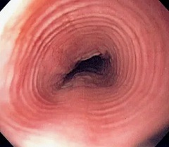 Лечение ожогов пищевода у детей2