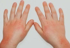 Причины контактного дерматита2