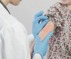 Лечение атопического дерматита2